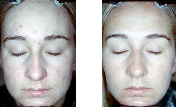 ProSystem-Acne-PIH-scaring-baseline-to-2-months-3-peels