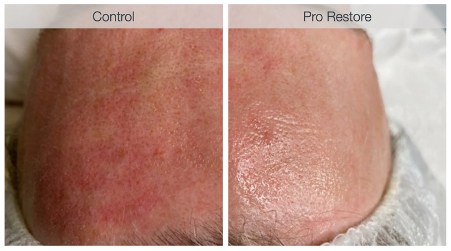 pro microneedling + pro restore = less downtime and amplified results